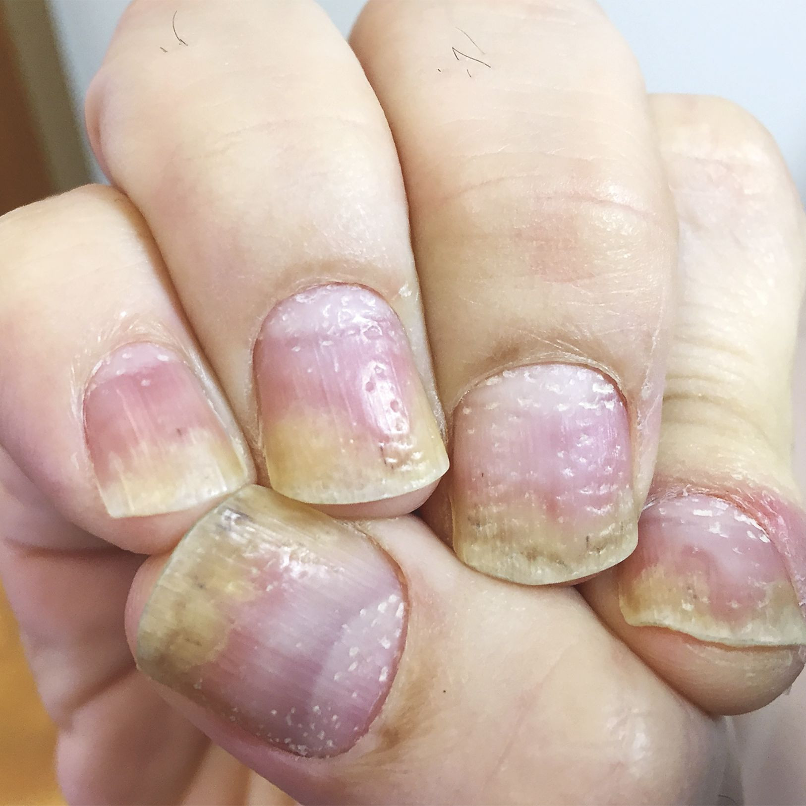Psoriasis Kuku